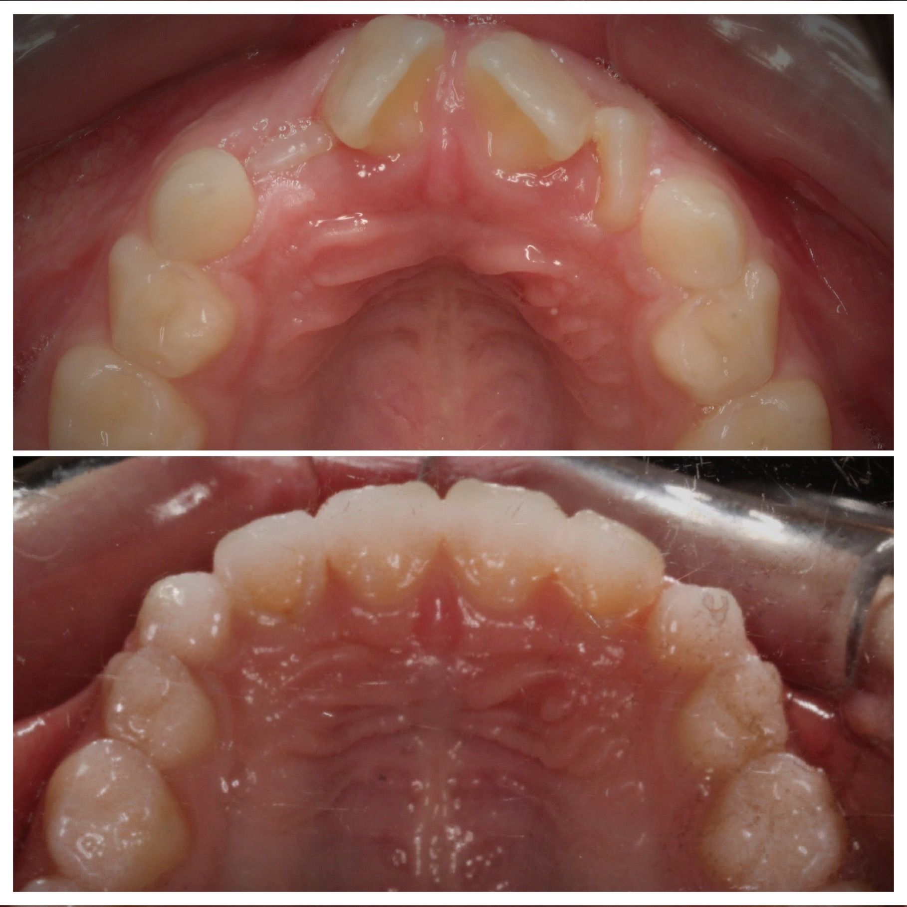 A before and after picture of a person 's teeth