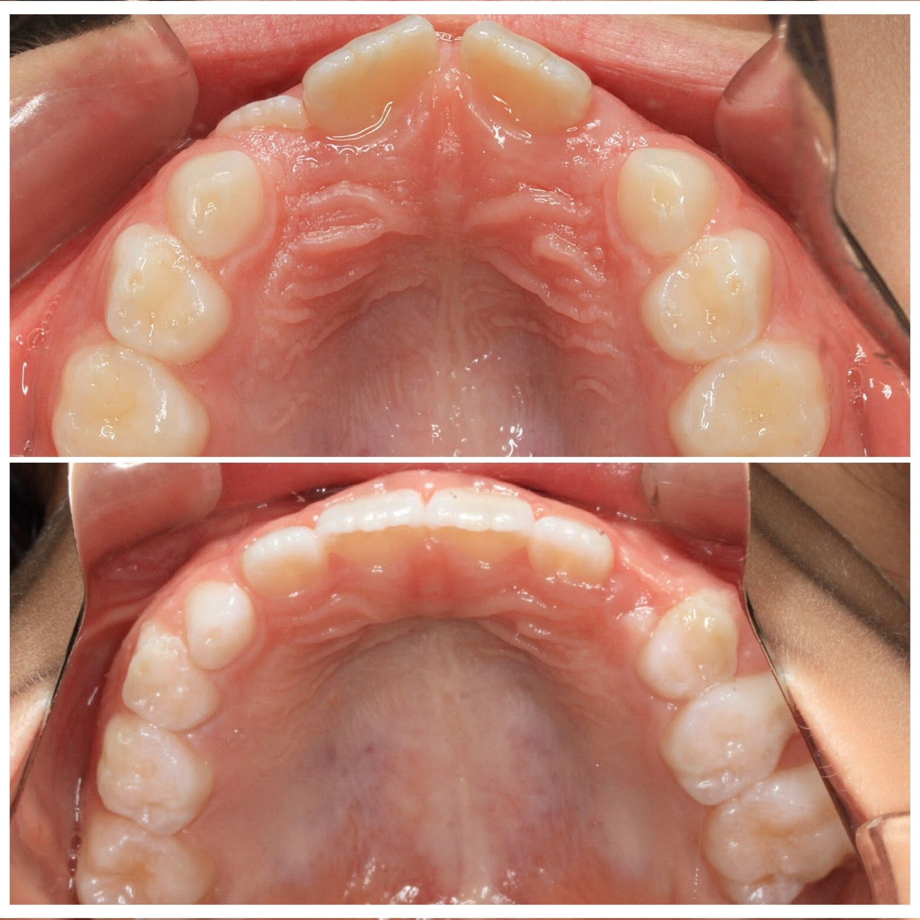 A before and after picture of a person 's teeth