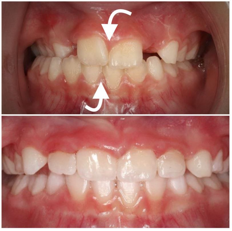 A before and after picture of a child 's teeth