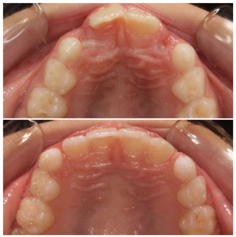 A before and after picture of a person 's teeth.