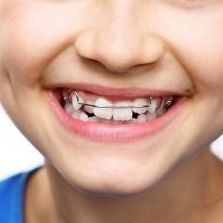 A close up of a child 's mouth with braces on it.