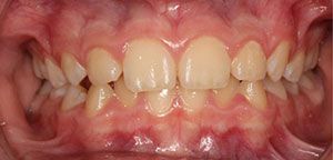 A close up of a person 's teeth and gums.
