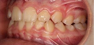 A close up of a person 's teeth and gums.