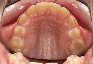 A close up of a person 's teeth and mouth.