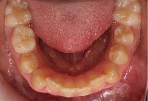 A close up of a person 's teeth with a tongue sticking out.