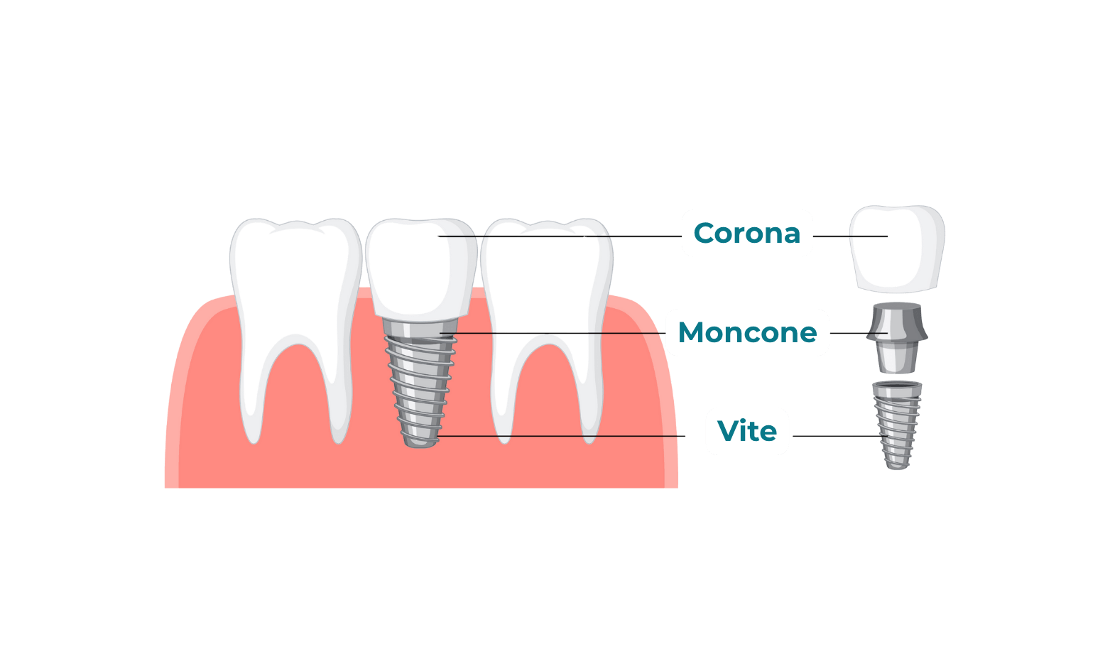 Schema di un impianto dentale che mostra corona, moncone e vite, con etichette in italiano.