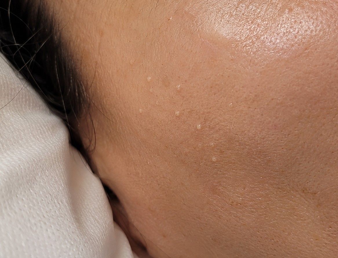 Client skin before professional blackhead removal at The Skin Studio, Arnold Nottingham — blackheads visible across the cheek and jaw