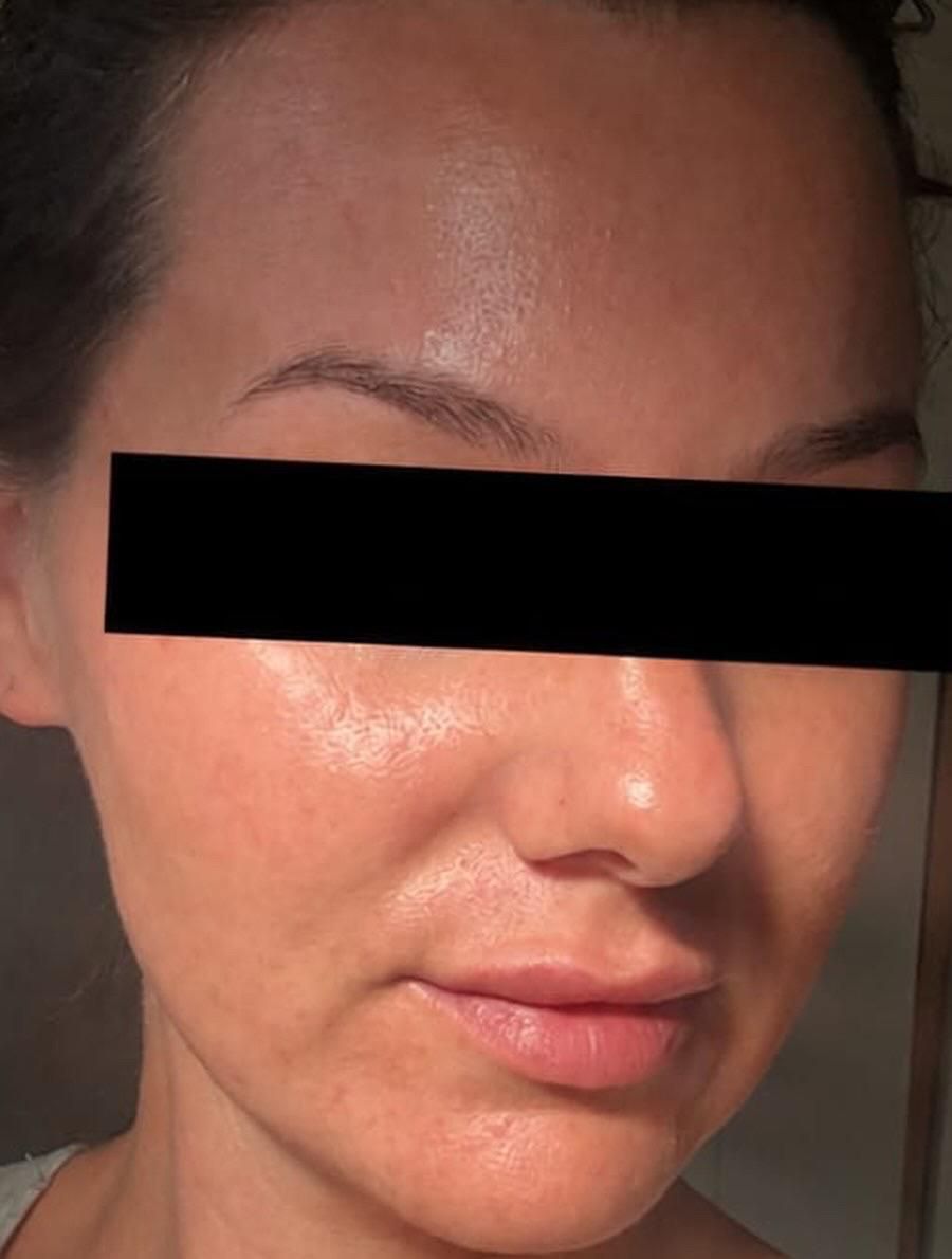 Client at the Skin Studio Nottingham after having a chemical peel