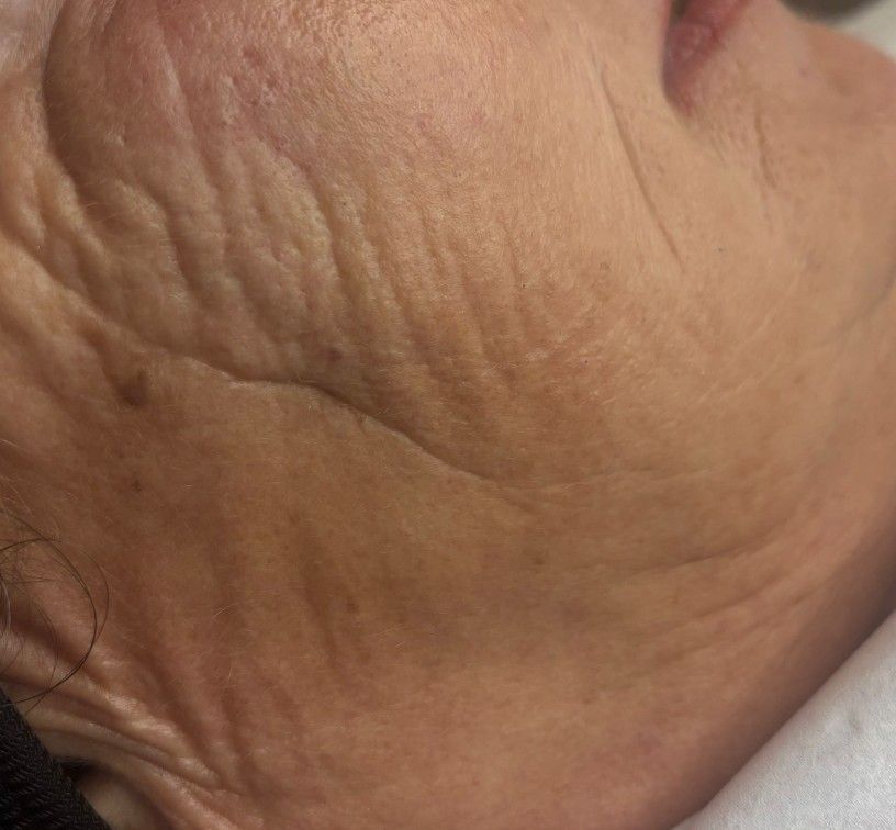 Client skin after professional blackhead removal at The Skin Studio, Arnold Nottingham — pores cleared and skin visibly refined