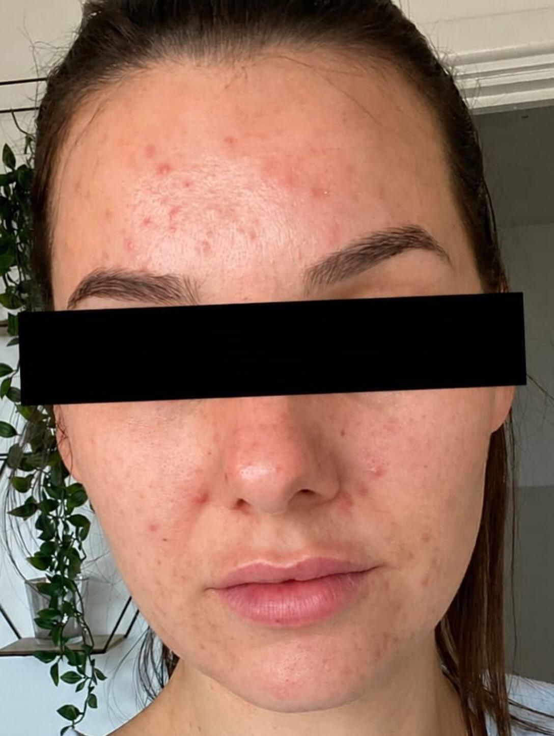 Client at the Skin Studio Nottingham before having a chemical peel