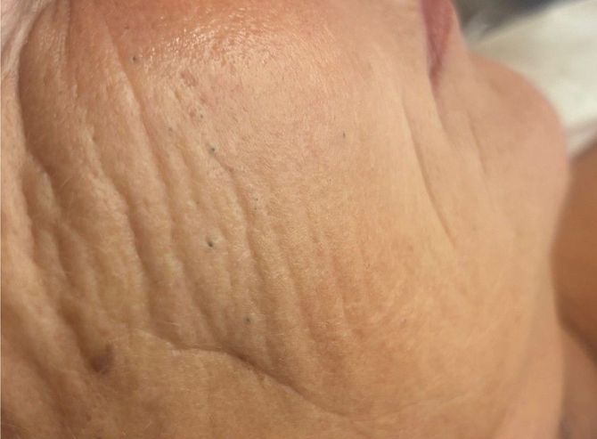 A Skin Studio client before undergoing a blackhead extraction treatment  in Nottingham