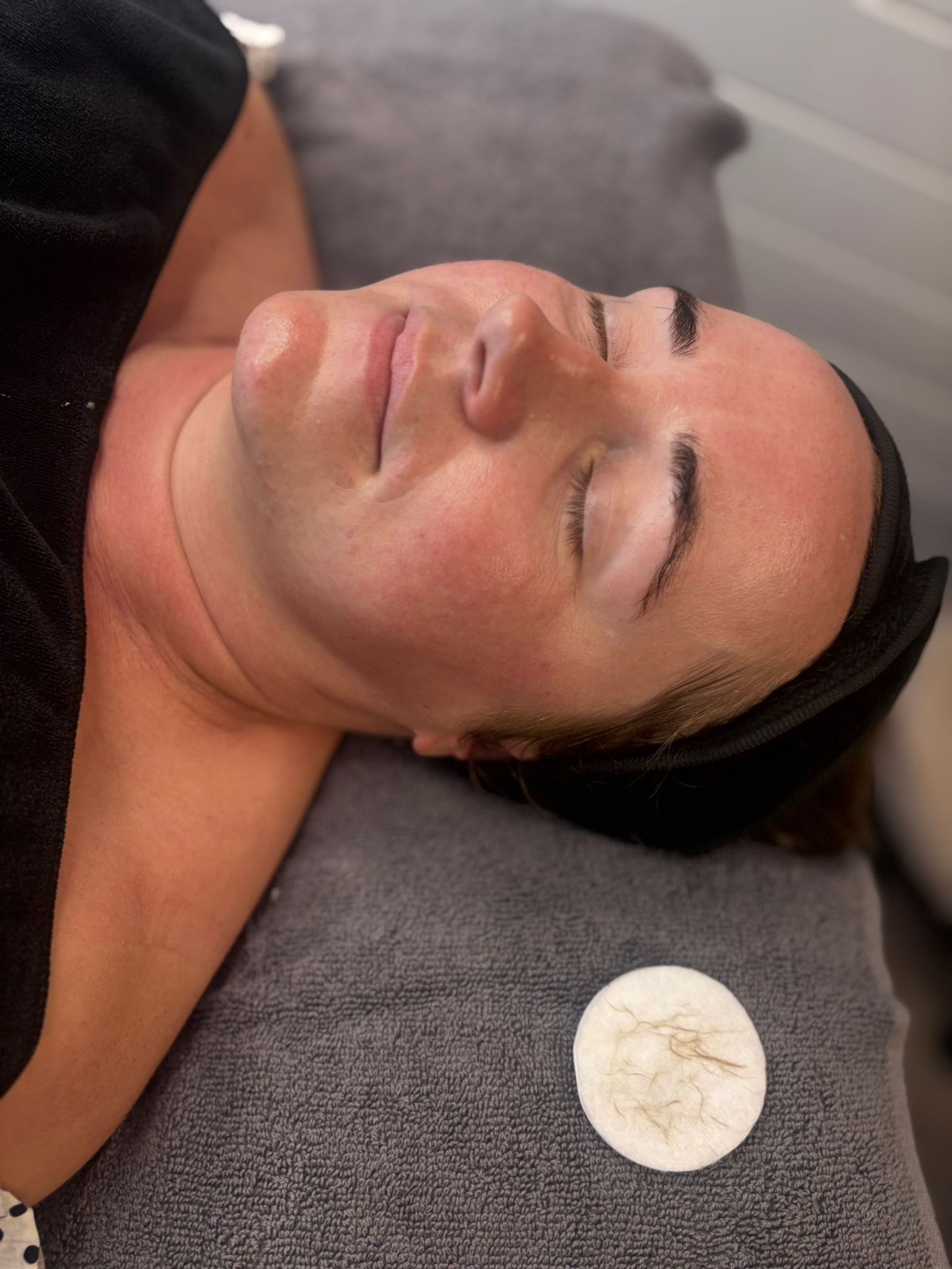 The Skin Studio dermaplaning  peach fuzz in Nottingham