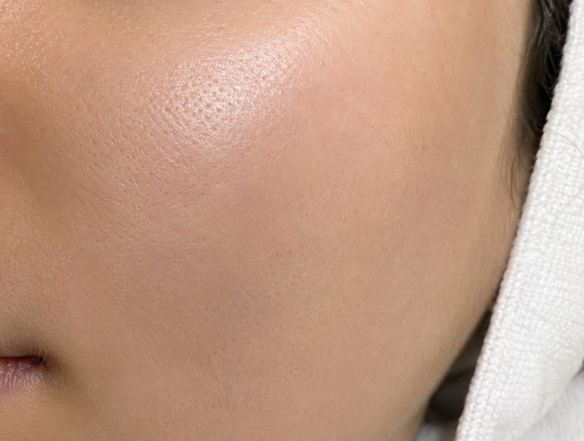 Close-up of smooth, clear skin on the cheek following professional milia removal — bumps cleared and skin texture refined, illustrative image