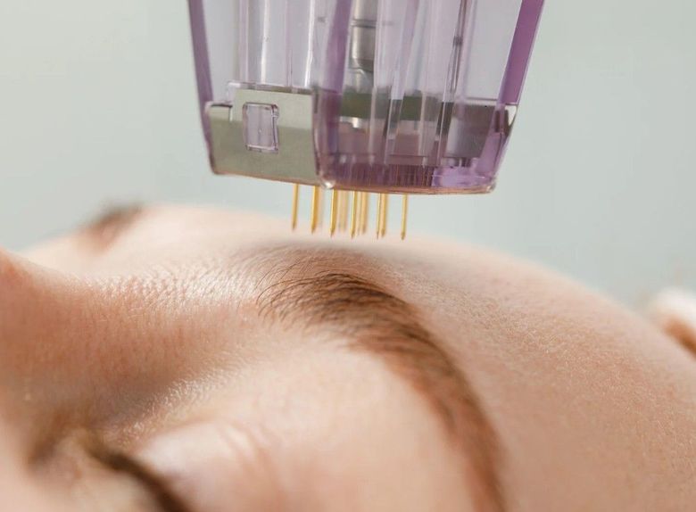 The Skin Studio performing microneedling on the forehead of a client in the Nottingham Clinic