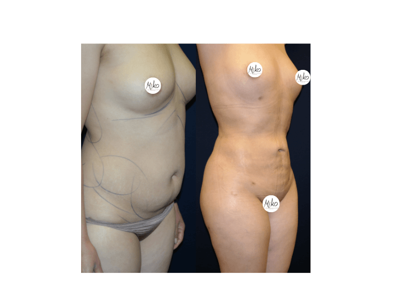 Liposuction in Beverly Hills