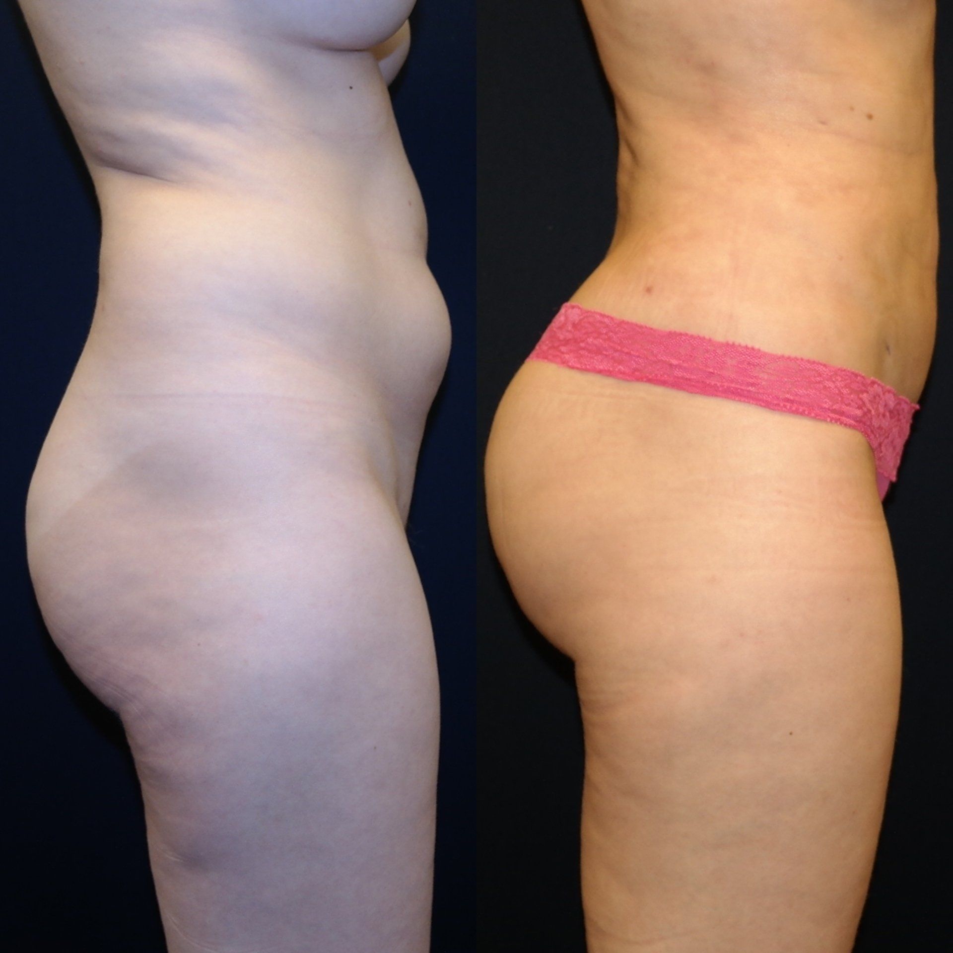 Brazilian butt lift to reshape boxy buttocks