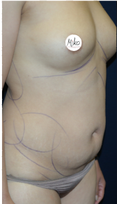 360 Liposuction i Beverly Hills