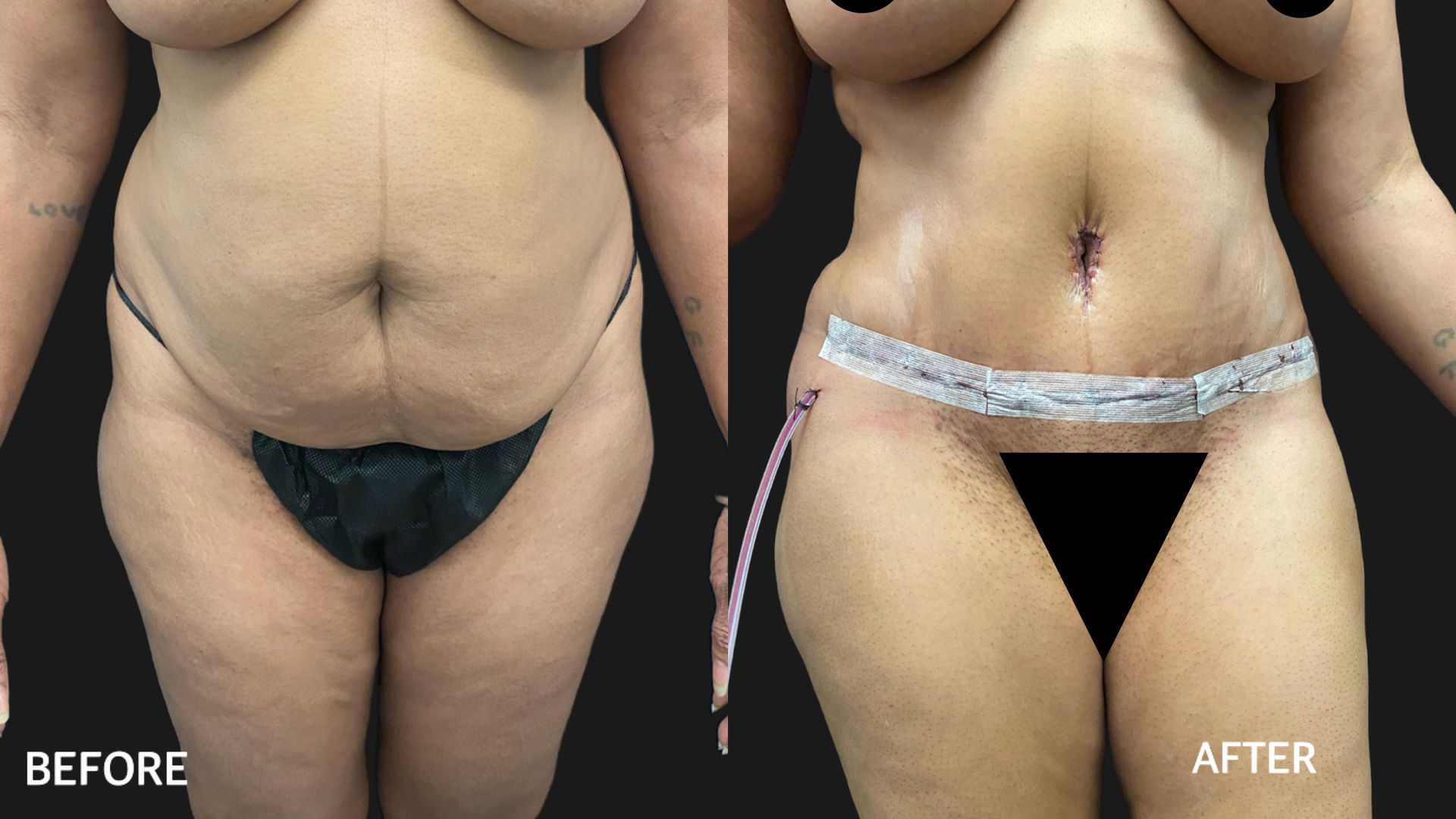 Before and after images showcasing the transformative effects of a tummy tuck procedure at MiKO Plastic Surgery, highlighting enhanced contours and renewed confidence.