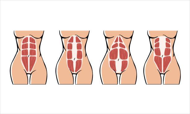diastasis recti repair surgery in Beverly Hills