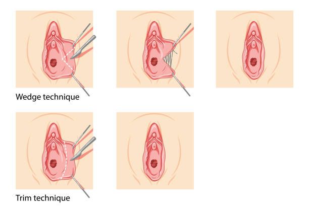Labiaplasty surgery in Beverly Hills