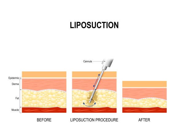 A diagram showing the process of liposuction.