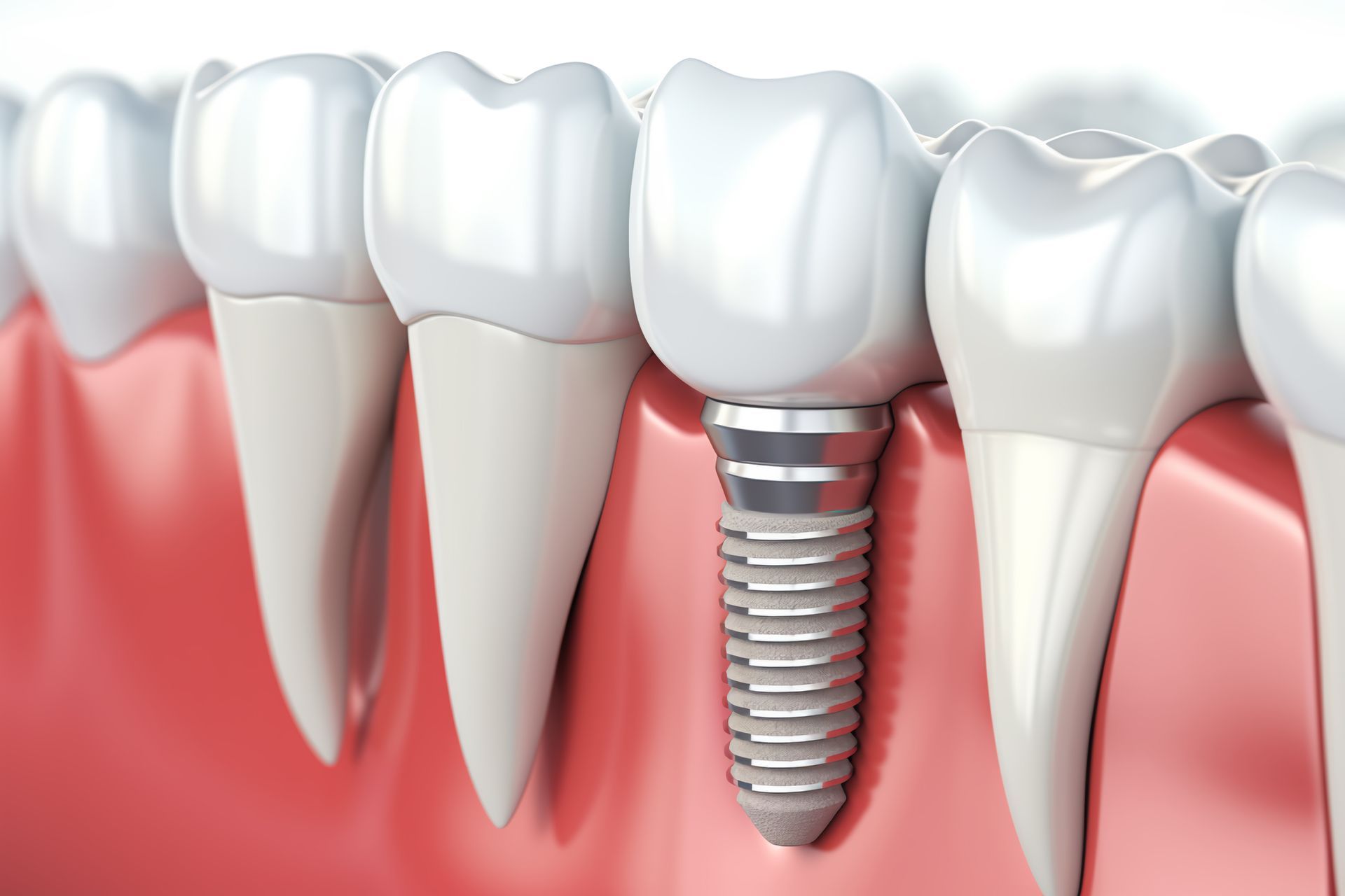 Implantacija