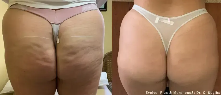 Side-by-side photos of a person's lower back and buttocks in white underwear, showing skin texture changes.