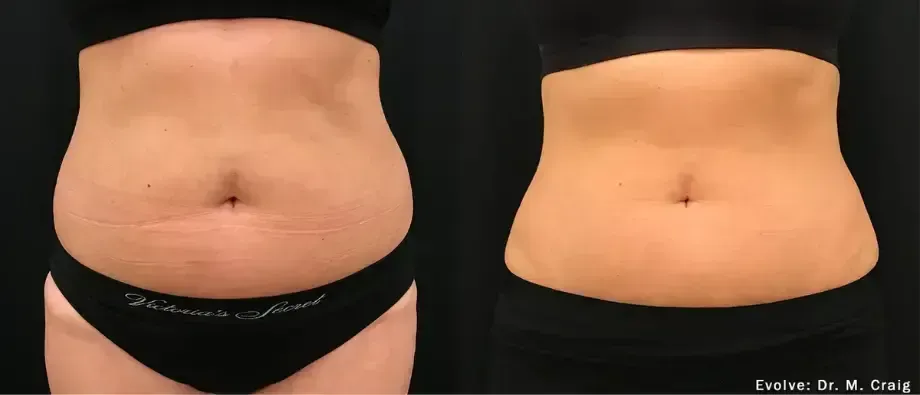 Side-by-side close-up of a torso in black underwear before and after abdominal smoothing