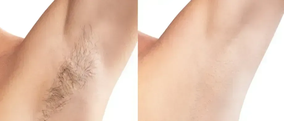 Underarm before and after hair removal, showing smoother skin on the right
