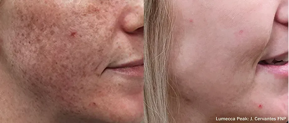 Side-by-side close-up of a cheek before and after skin treatment, showing reduced redness and clearer skin