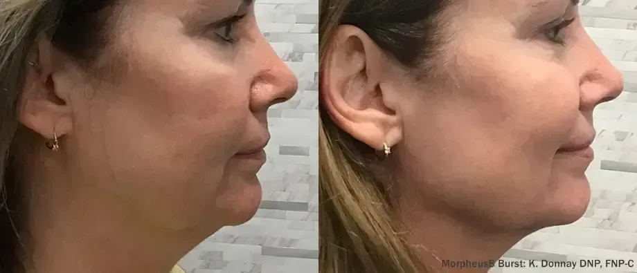 Side-by-side profile photos of a woman before and after cosmetic facial treatment