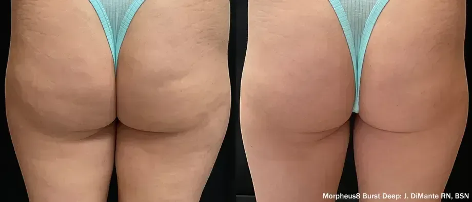 Side-by-side close-up of a person's lower back and buttocks in a light blue thong, front and back views
