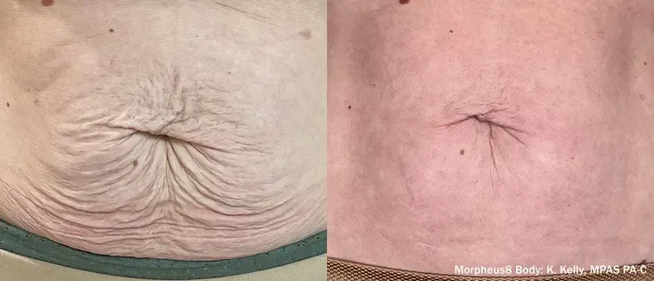 Side-by-side close-up of wrinkled skin before and after treatment, left more creased, right smoother.