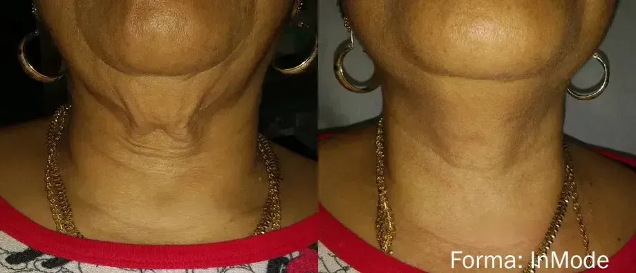 Close-up of neck skin before and after treatment, showing smoother skin on the right