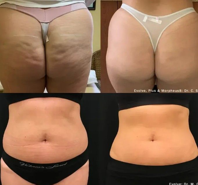 Before-and-after collage of a midsection and hips in underwear, showing visible slimming and waist reduction.