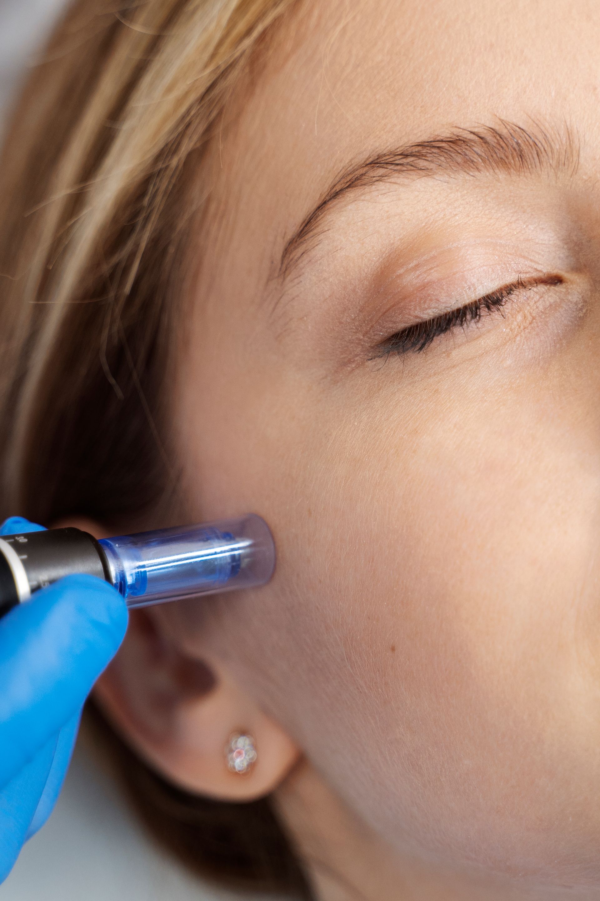 Blue-gloved hand using a facial treatment device on a woman’s cheek