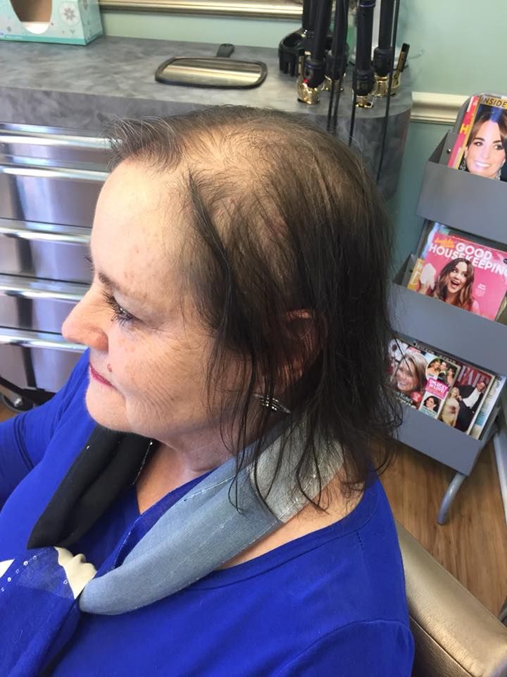 Woman with thinning hair at salon, wearing blue top and neck wrap, looking left.
