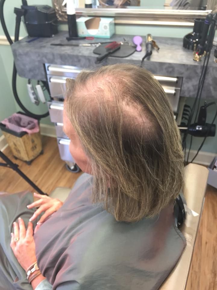 Woman with thinning hair at a salon, seated and wearing a salon cape, angled view of her head.