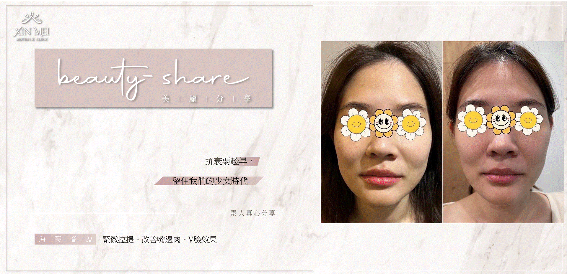 #分享 海芙音波初體驗 拉提效果比預期更有感