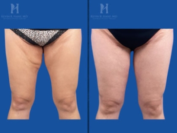 Before and after image