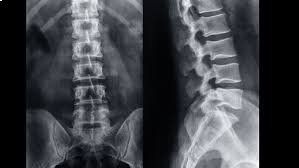 Radiografia spina dorsale