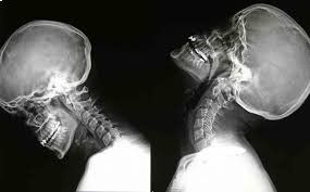 Radiografia collo