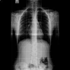 Radiografia schiena