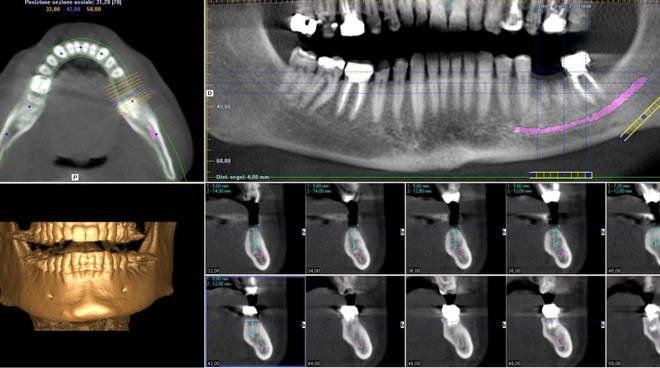 Radiografia denti