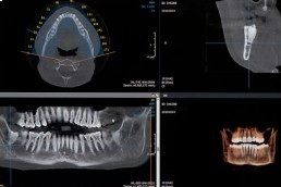 Panoramica denti