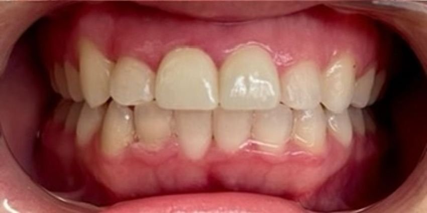 after invisalign