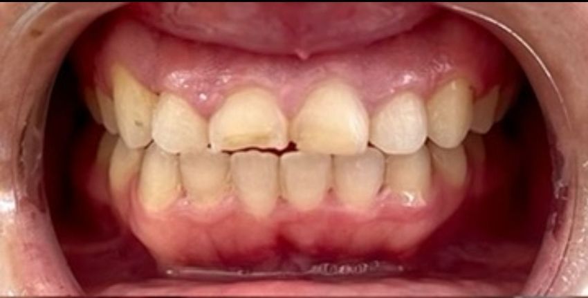 before invisalign