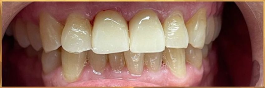 after crown implants