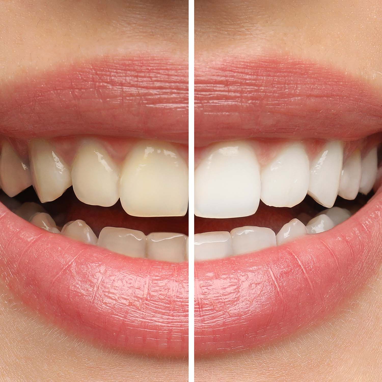 Comparison of teeth before and after whitening; yellow vs. bright white. Smiling mouth.