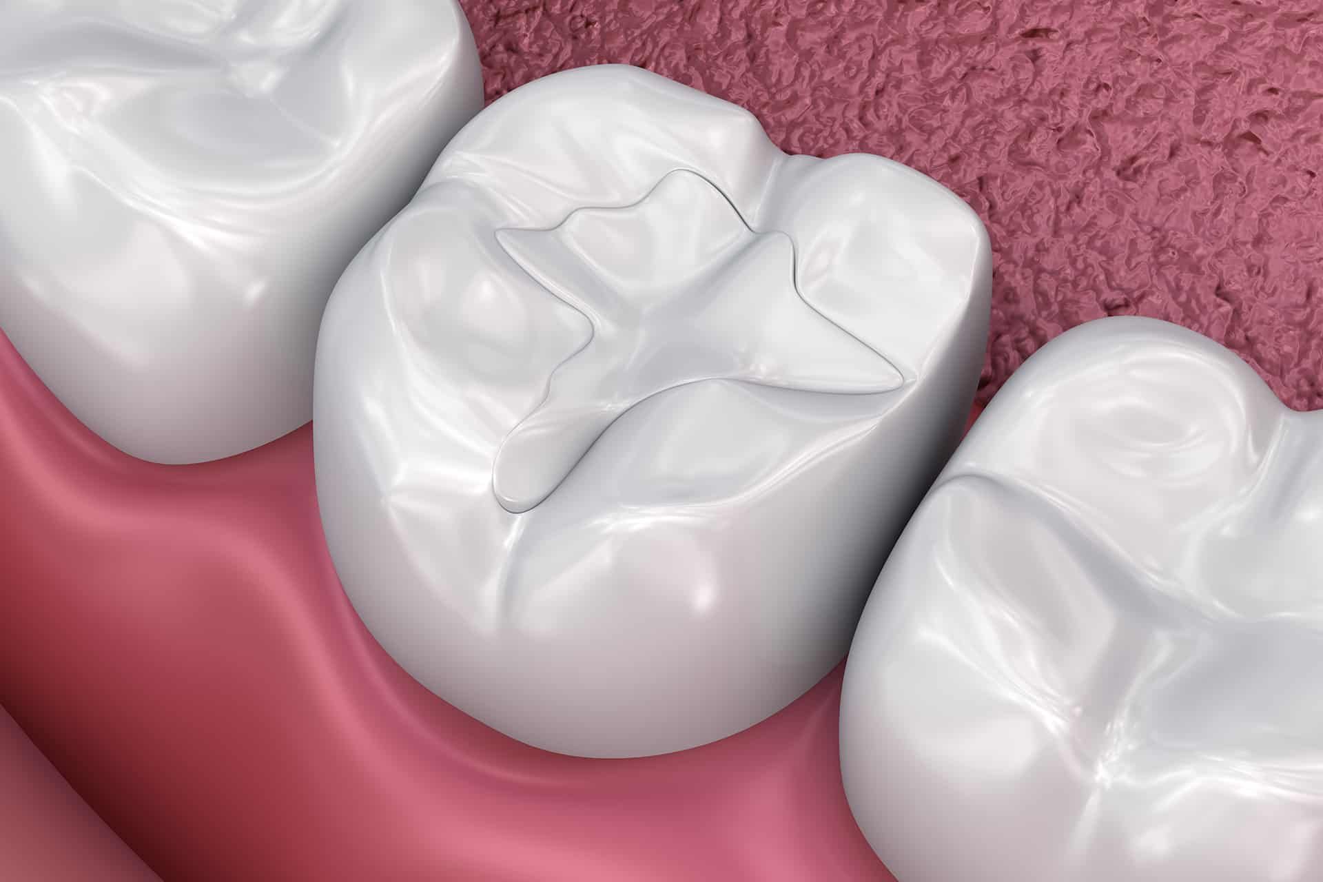 Close-up of a tooth with a dental filling, showing its white, smooth surface and the surrounding gum tissue.
